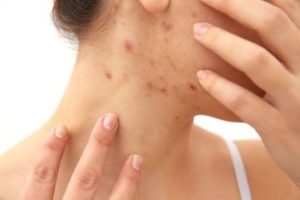 Acne and oil