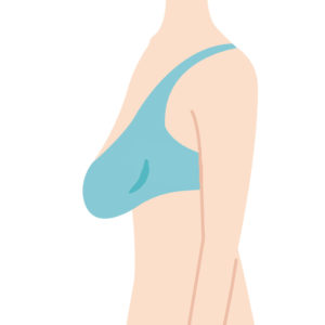 Sagging Breasts