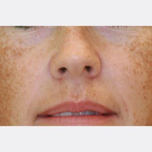 Melasma