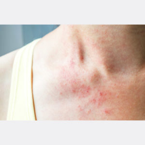 Skin rash