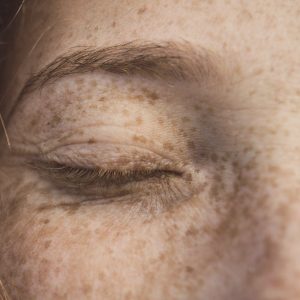 Hyperpigmentation