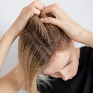 Dandruff Means Your Scalp is Dry